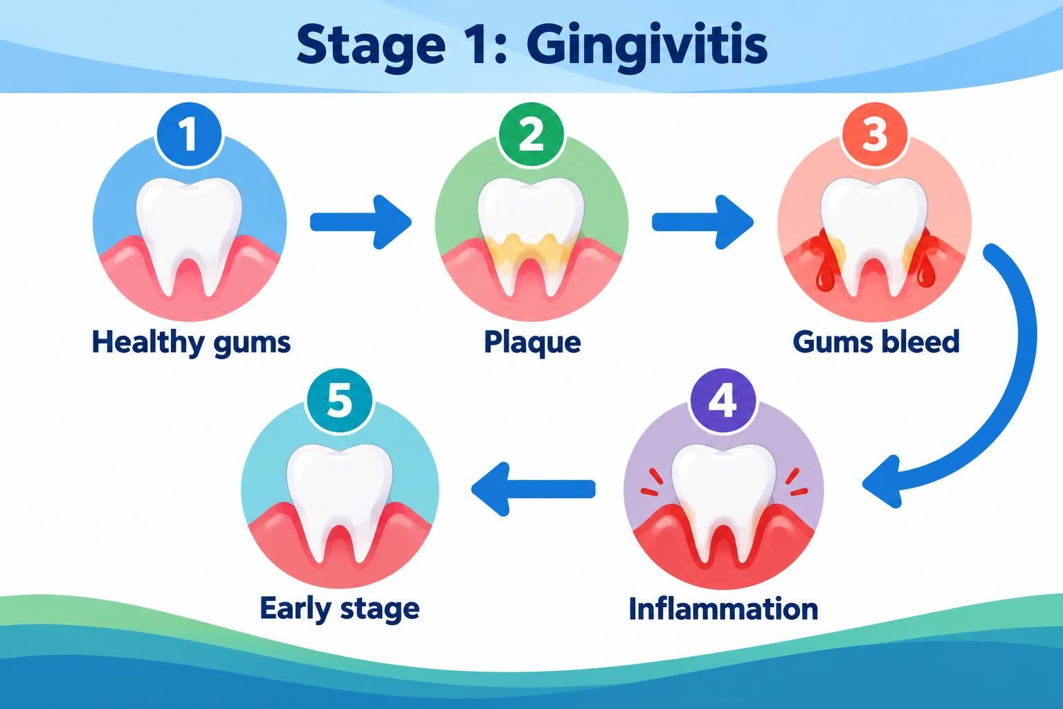 Gingivitis timeline showing healthy gums, plaque, bleeding, and inflammation
