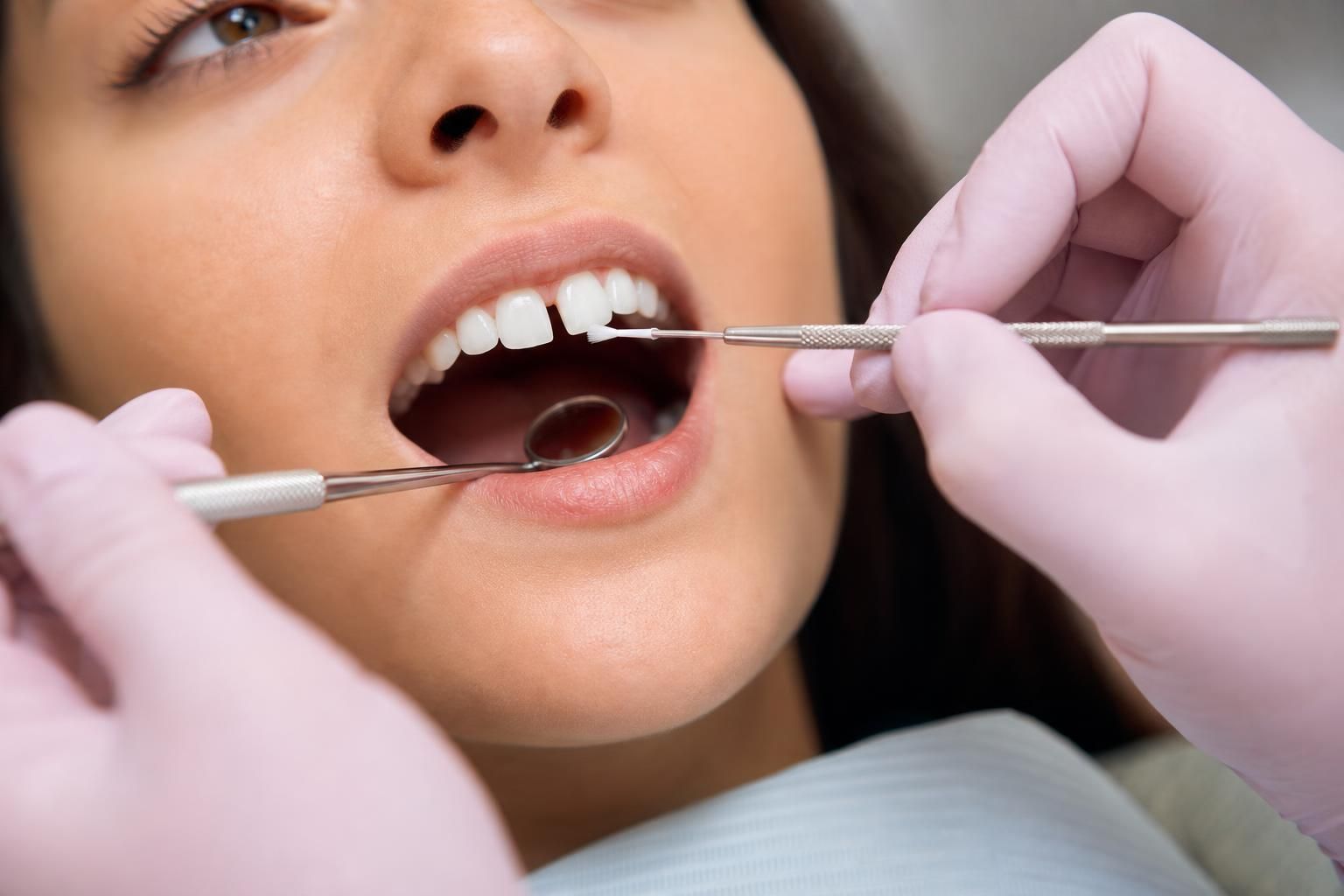 Dentist applies bonding material to a front tooth gap