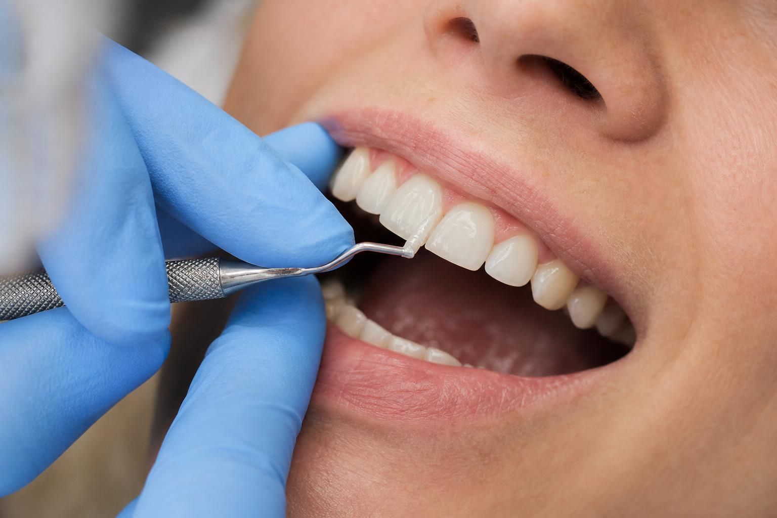 Dentist applies bonding material to front tooth